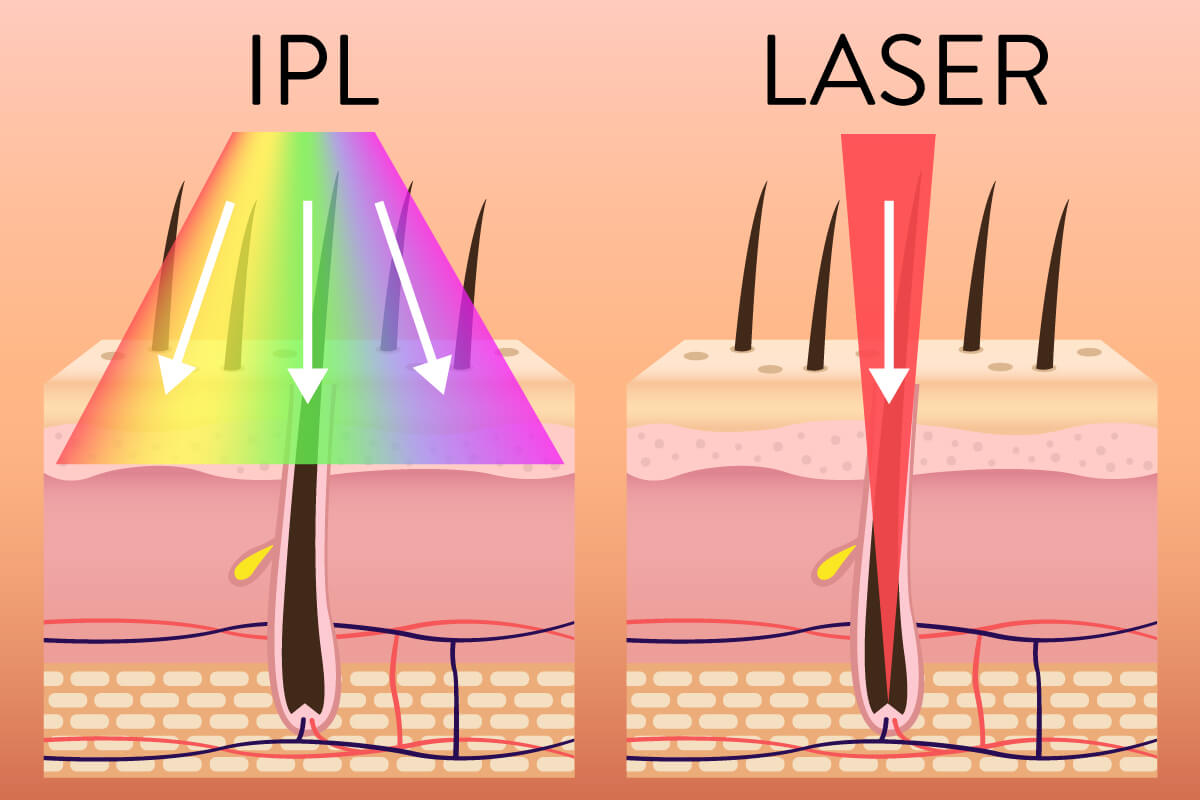 Unterschied zwischen IPL und Laser-Haarentfernung
