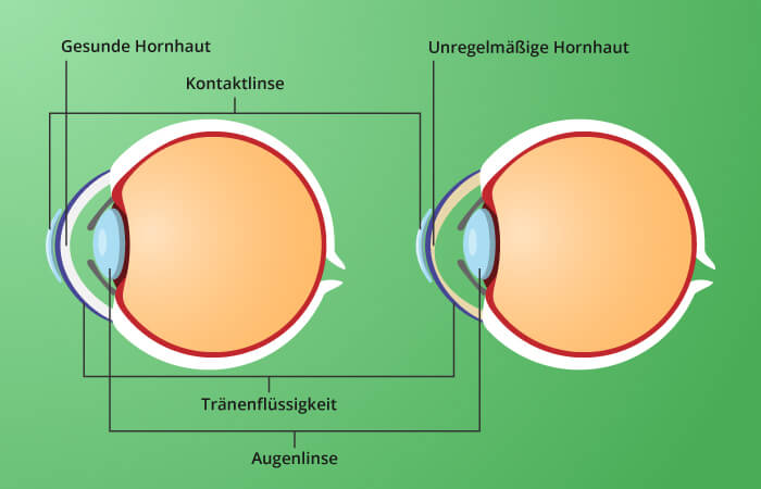 Korrekturprinzip Kontaktlinse