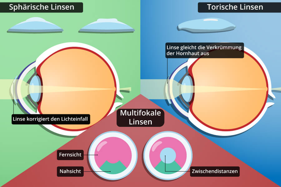 Kontaktlinsen zur Korrektur von Fehlsichtigkeiten