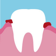 Gingivitis